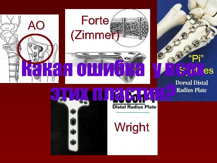 AO Forte (Zimmer) “Pi” Synthes Какая ошибка у всех этих пластин? Wright 