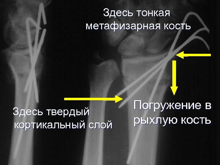 Здесь тонкая метафизарная кость Здесь твердый кортикальный слой Погружение в рыхлую кость 