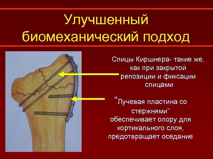 Улучшенный биомеханический подход Спицы Киршнера- такие же, как при закрытой репозиции и фиксации спицами