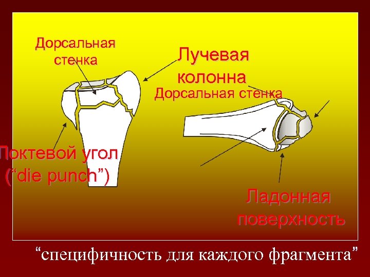 Дорсальная стенка Лучевая колонна Дорсальная стенка Локтевой угол (“die punch”) Ладонная поверхность “специфичность для