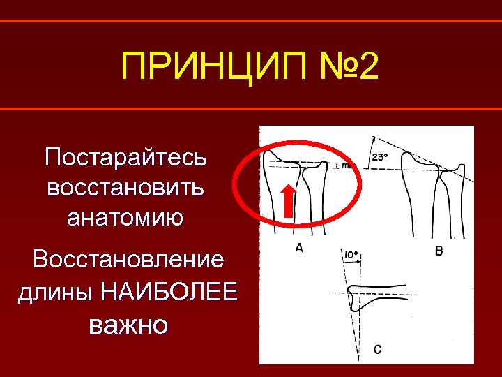 ПРИНЦИП № 2 Постарайтесь восстановить анатомию Восстановление длины НАИБОЛЕЕ важно 