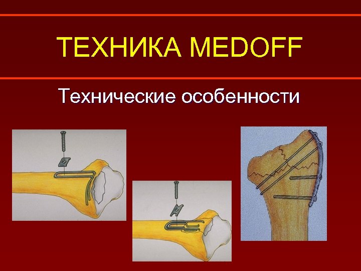 ТЕХНИКА MEDOFF Технические особенности 