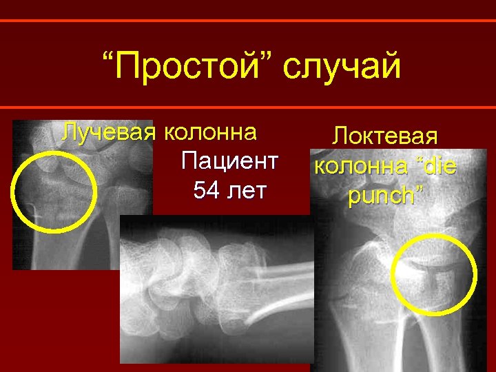 “Простой” случай Лучевая колонна Пациент 54 лет Локтевая колонна “die punch” 
