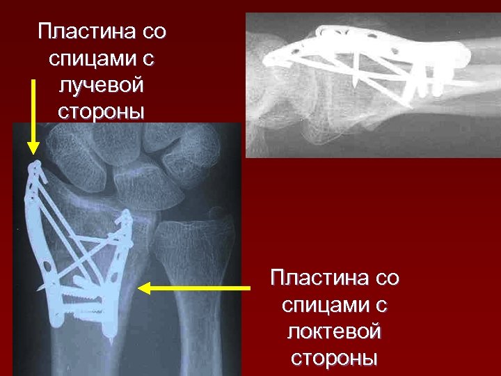 Пластина со спицами с лучевой стороны Пластина со спицами с локтевой стороны 