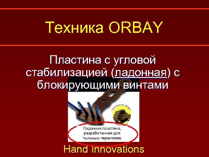 Техника ORBAY Пластина с угловой стабилизацией (ладонная) с блокирующими винтами Ладонная пластина, разработанная для