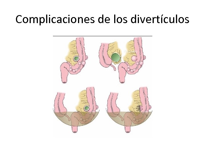 Complicaciones de los divertículos Absceso 