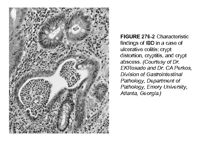 FIGURE 276 -2 Characteristic findings of IBD in a case of ulcerative colitis: crypt