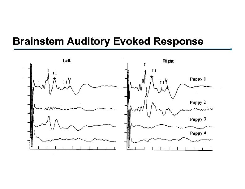 Brainstem Auditory Evoked Response 
