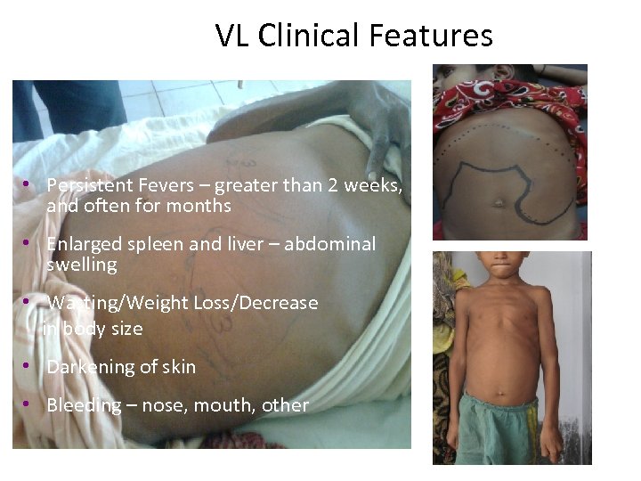  VL Clinical Features • Persistent Fevers – greater than 2 weeks, and often