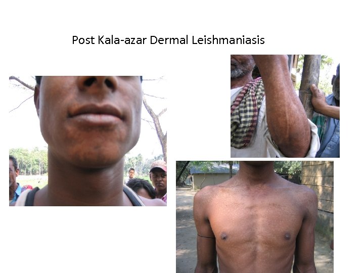 Post Kala-azar Dermal Leishmaniasis 