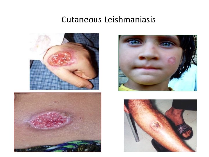  Cutaneous Leishmaniasis 