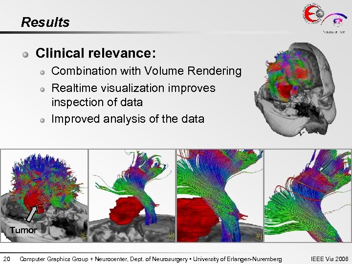 Results Clinical relevance: Combination with Volume Rendering Realtime visualization improves inspection of data Improved