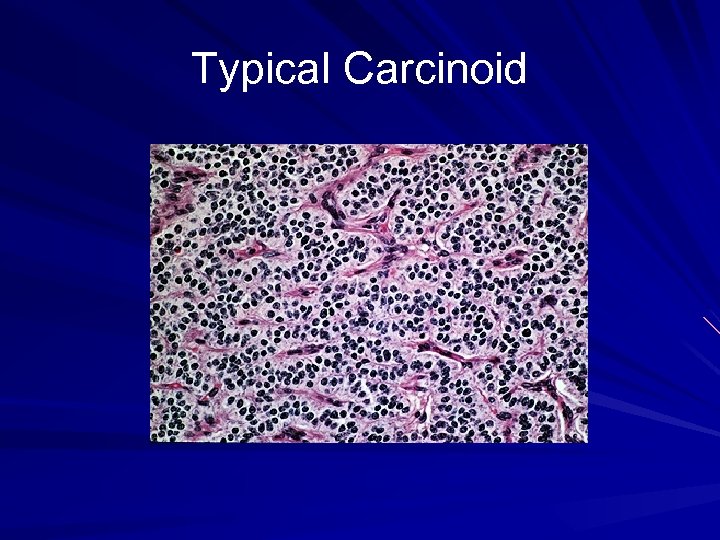 Typical Carcinoid 