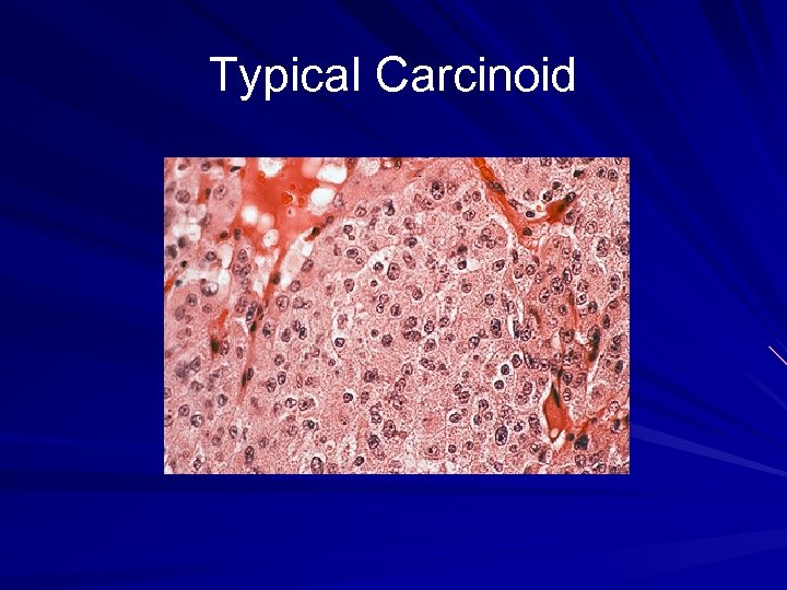 Typical Carcinoid 