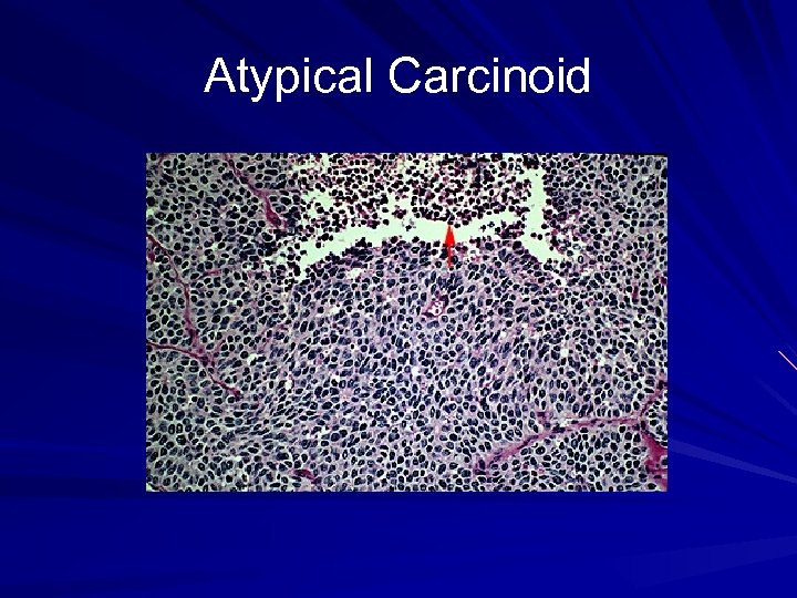 Atypical Carcinoid 