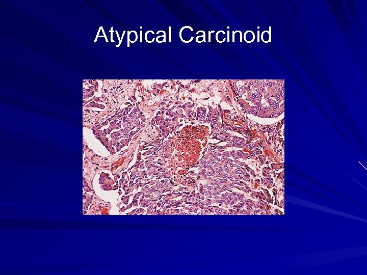 Atypical Carcinoid 
