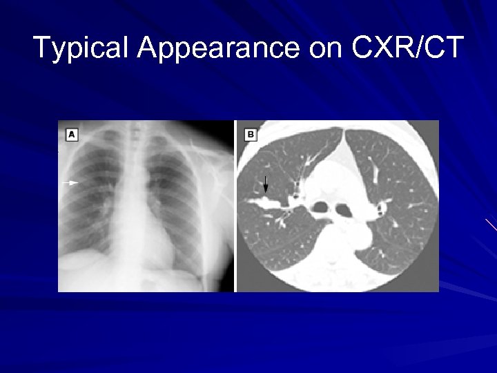 Typical Appearance on CXR/CT 