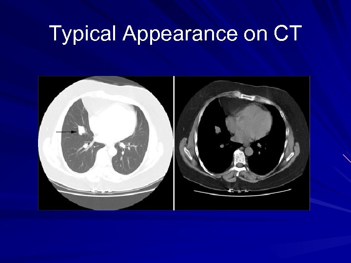 Typical Appearance on CT 