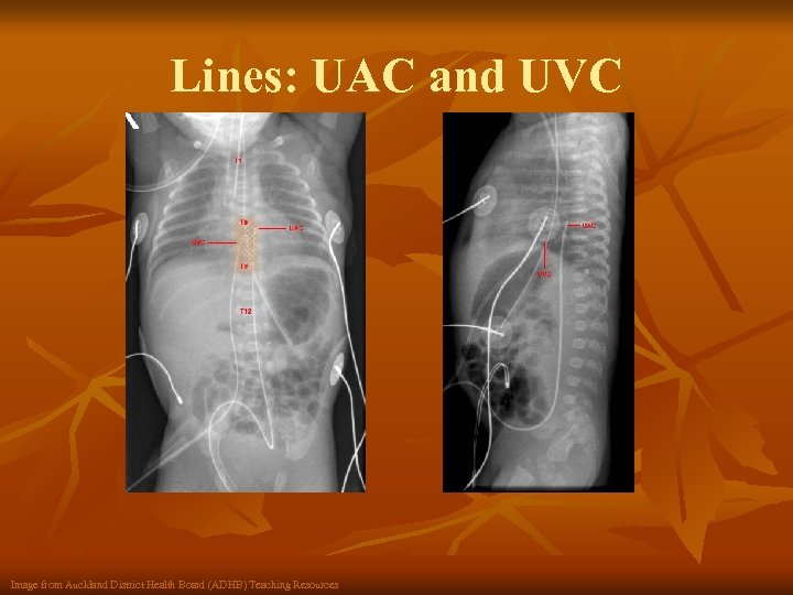 Lines: UAC and UVC Image from Auckland District Health Board (ADHB) Teaching Resources 