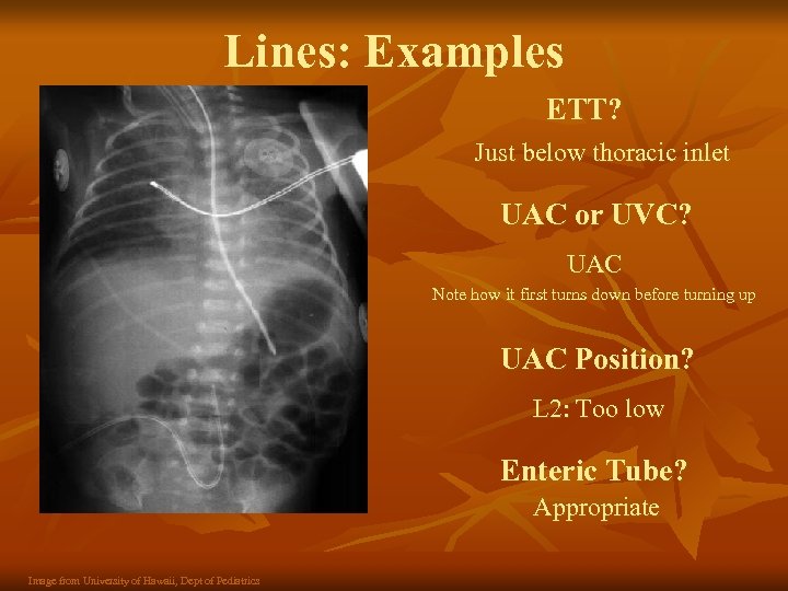 Lines: Examples ETT? Just below thoracic inlet UAC or UVC? UAC Note how it