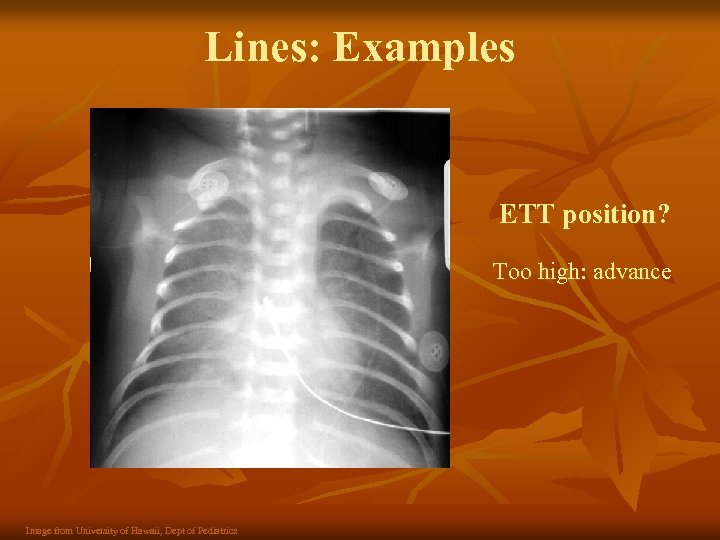 Lines: Examples ETT position? Too high: advance Image from University of Hawaii, Dept of