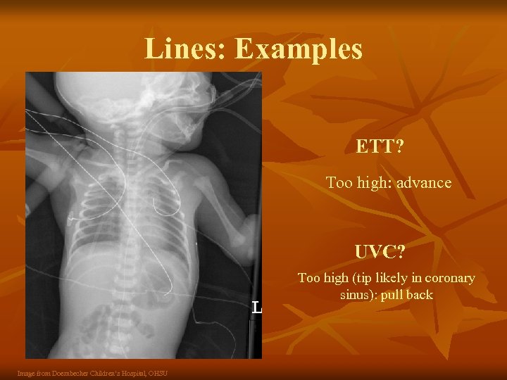 Lines: Examples ETT? Too high: advance UVC? Too high (tip likely in coronary sinus):