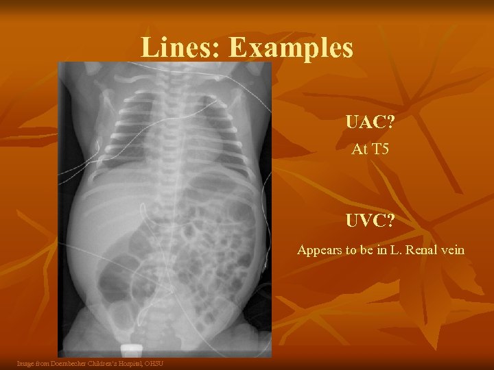 Lines: Examples UAC? At T 5 UVC? Appears to be in L. Renal vein