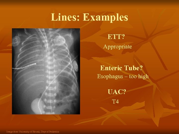 Lines: Examples ETT? Appropriate Enteric Tube? Esophagus – too high UAC? T 4 Image