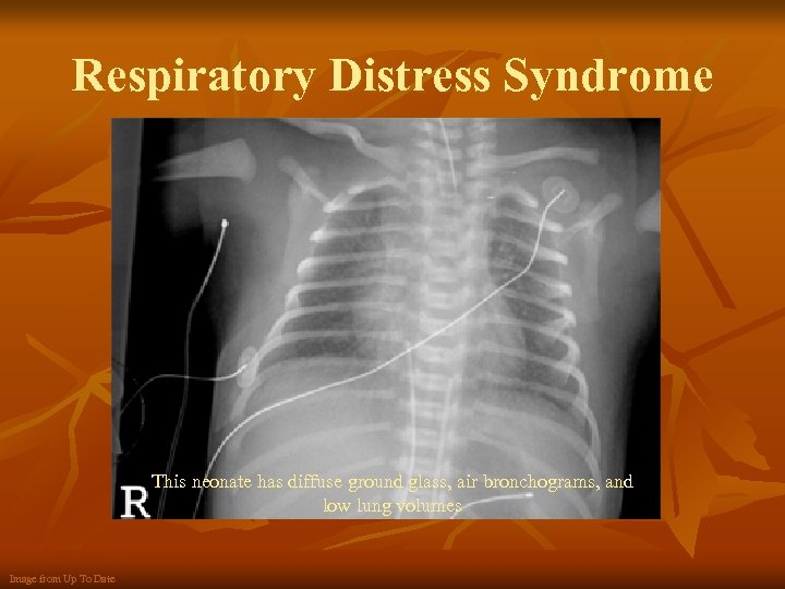 Respiratory Distress Syndrome This neonate has diffuse ground glass, air bronchograms, and low lung