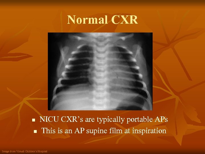 Normal CXR NICU CXR’s are typically portable APs n This is an AP supine