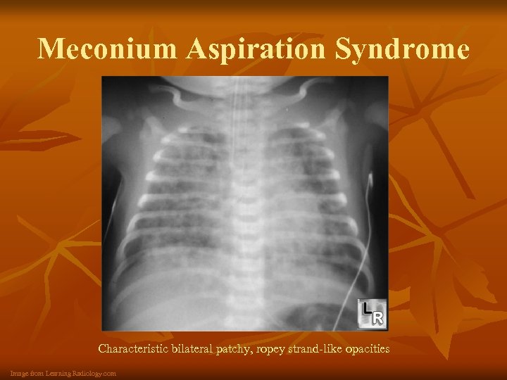 Meconium Aspiration Syndrome Characteristic bilateral patchy, ropey strand-like opacities Image from Learning Radiology. com