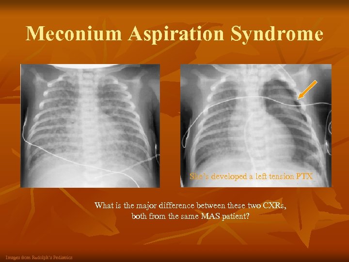 Meconium Aspiration Syndrome She’s developed a left tension PTX What is the major difference