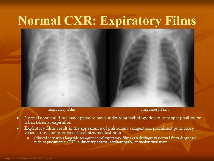 Normal CXR: Expiratory Films Expiratory Film n n Inspiratory Film Normal neonatal films may