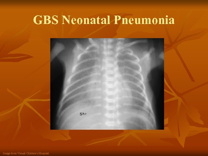 GBS Neonatal Pneumonia Image from Virtual Children’s Hospital 