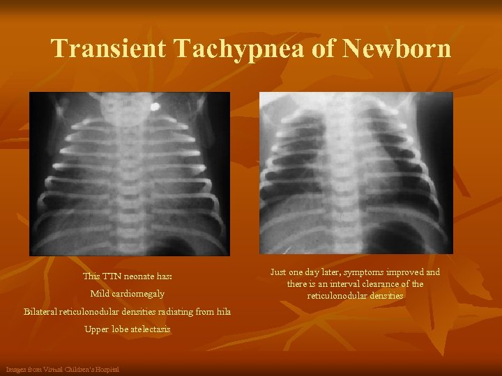 Transient Tachypnea of Newborn This TTN neonate has: Mild cardiomegaly Bilateral reticulonodular densities radiating