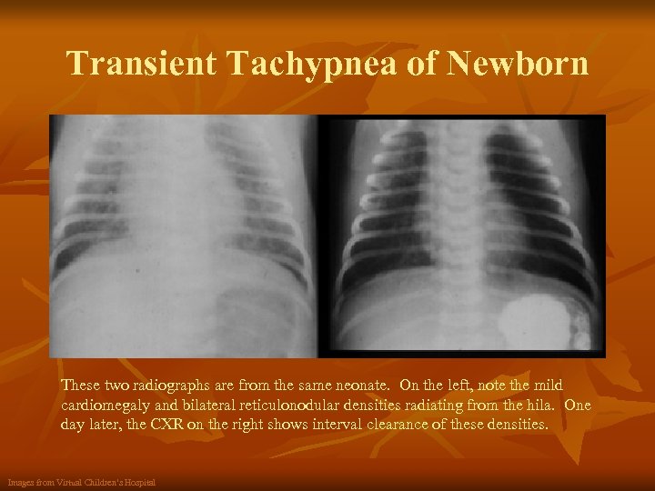 Transient Tachypnea of Newborn These two radiographs are from the same neonate. On the