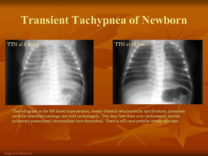 Transient Tachypnea of Newborn TTN at 6 hours TTN at 48 hours The radiograph