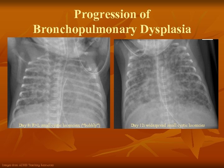 Progression of Bronchopulmonary Dysplasia Day 8: R>L small cystic lucencies; (“bubbly”) Images from ADHB