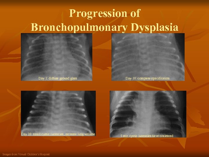 Progression of Bronchopulmonary Dysplasia Day 1: diffuse ground glass Day 10: complete opacification Day