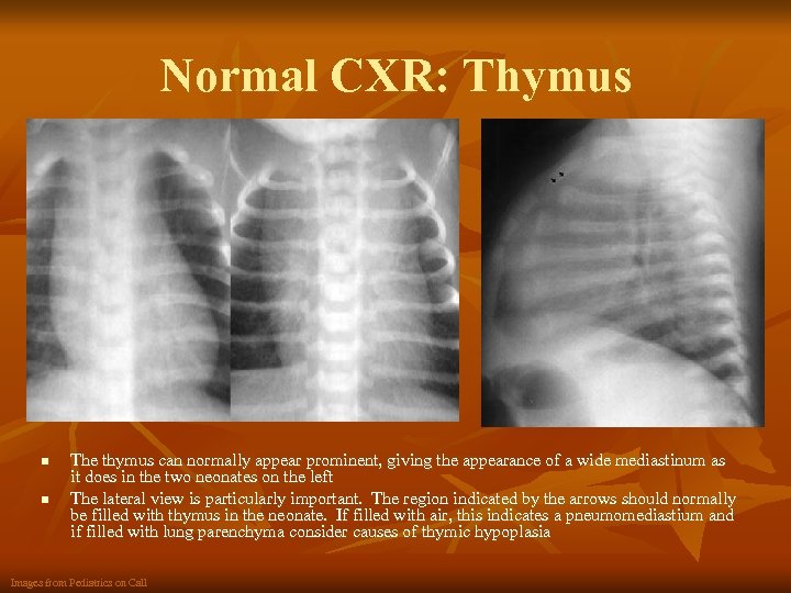 Normal CXR: Thymus n n The thymus can normally appear prominent, giving the appearance