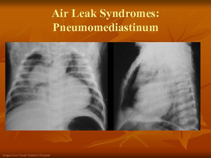 Air Leak Syndromes: Pneumomediastinum Images from Virtual Children’s Hospital 