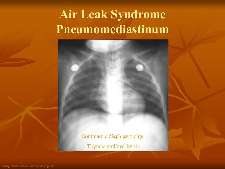 Air Leak Syndrome Pneumomediastinum Continuous diaphragm sign Thymus outlined by air Image from Virtual