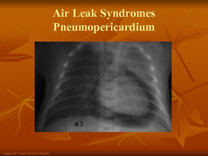 Air Leak Syndromes Pneumopericardium Image from Virtual Children’s Hospital 