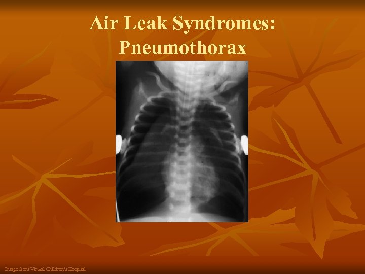 Air Leak Syndromes: Pneumothorax Image from Virtual Children’s Hospital 