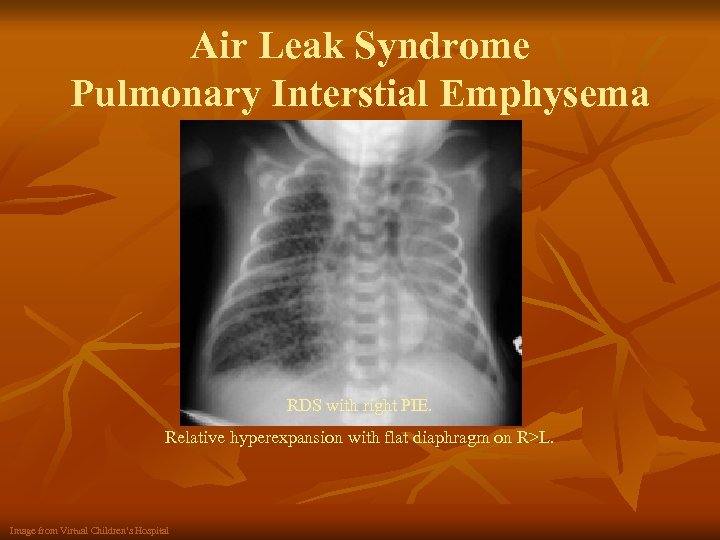 Air Leak Syndrome Pulmonary Interstial Emphysema RDS with right PIE. Relative hyperexpansion with flat