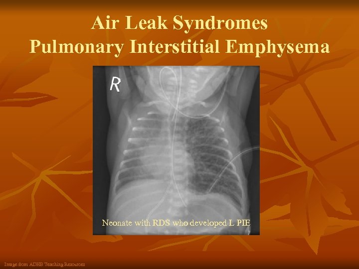 Air Leak Syndromes Pulmonary Interstitial Emphysema Neonate with RDS who developed L PIE Image