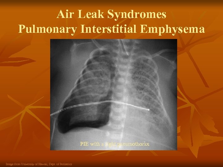 Air Leak Syndromes Pulmonary Interstitial Emphysema PIE with a right pneumothorax Image from University