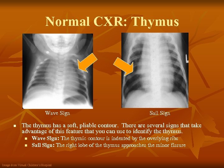 Normal CXR: Thymus Wave Sign n Sail Sign The thymus has a soft, pliable