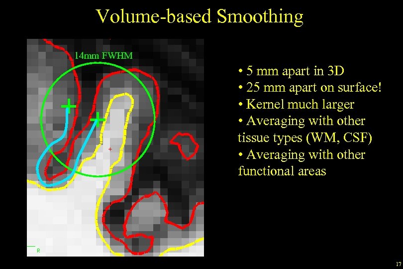 Volume-based Smoothing 14 mm FWHM • 5 mm apart in 3 D • 25