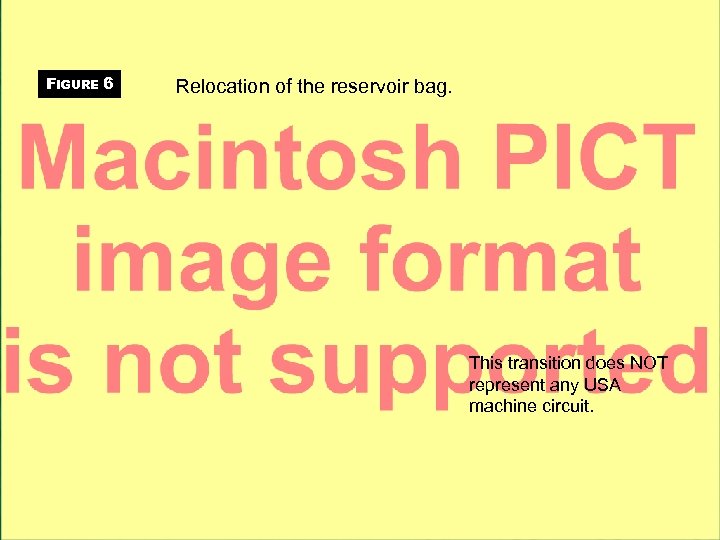 FIGURE 6 Relocation of the reservoir bag. This transition does NOT represent any USA